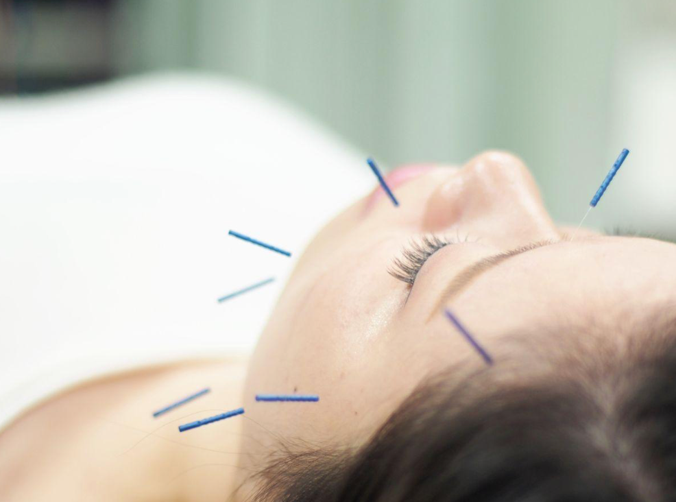 Facial Acupuncture