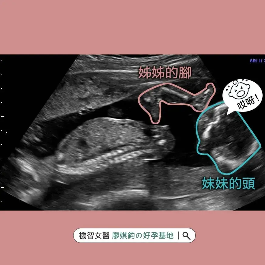 小美媽咪試管雙胞胎驚喜