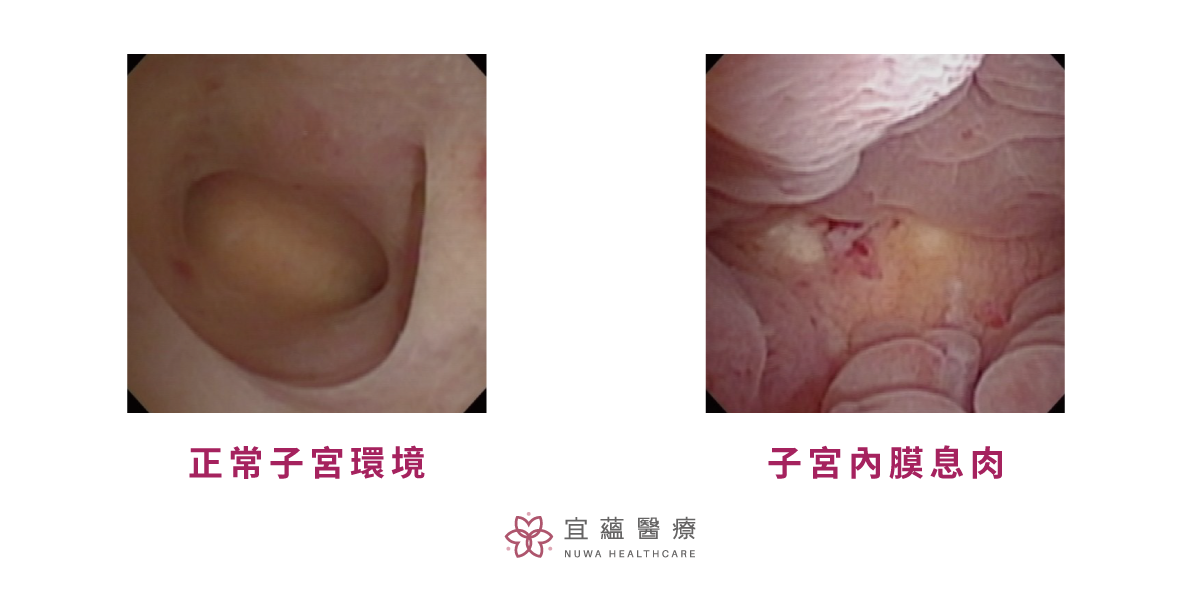 正常子宮環境與有子宮內膜息肉