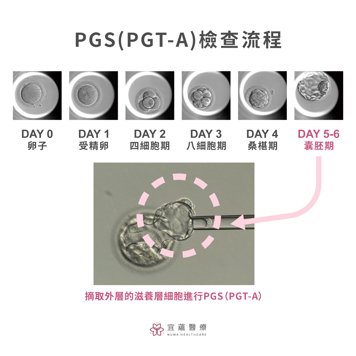 PGS(PGT-A)的切片檢查流程，摘取外層的滋養層細胞進行PGS(PGT-A)