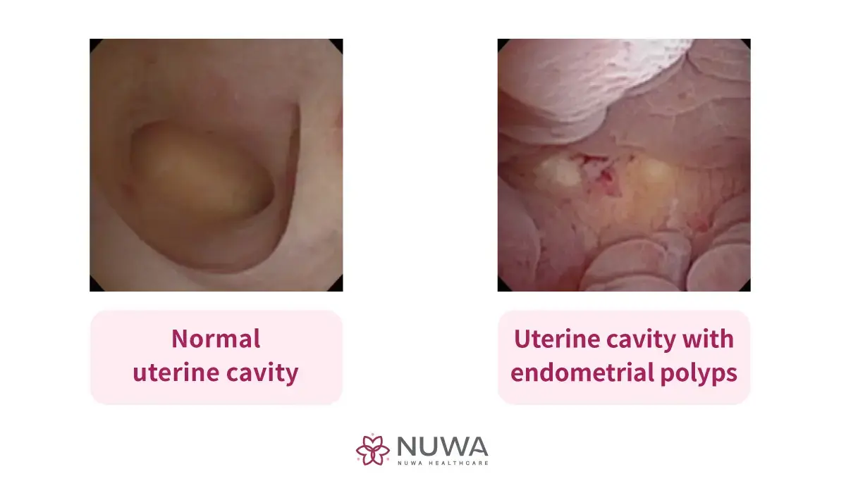 Hysteroscopy