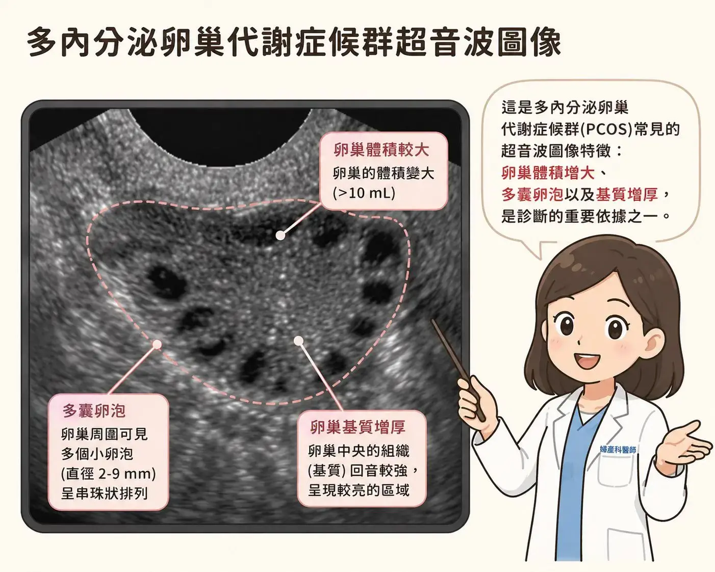 多囊性卵巢症候群（PCOS／PMOS）超音波影像，顯示卵巢周圍多顆小濾泡呈現珍珠項鍊樣排列
